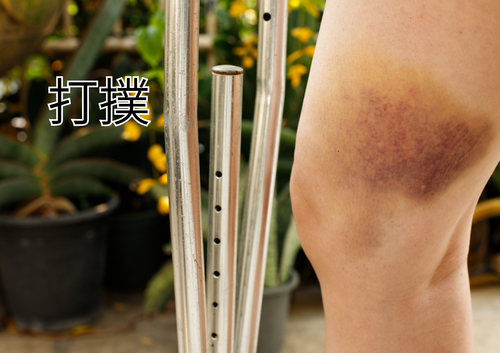 打撲でお悩みの方へ